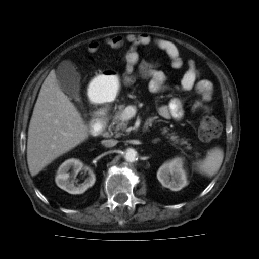 File:Colon cancer with duodenal invasion (Radiopaedia 16278-15958 A 21).jpg