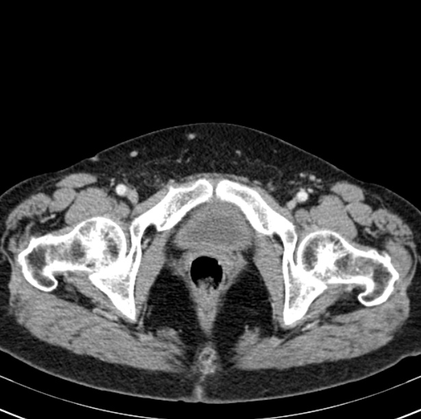 Colon carcinoma with hepatic metastases (Radiopaedia 29477-29961 A 113).jpg