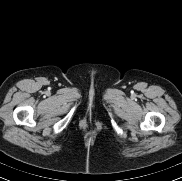 Colon carcinoma with hepatic metastases (Radiopaedia 29477-29961 A 129).jpg