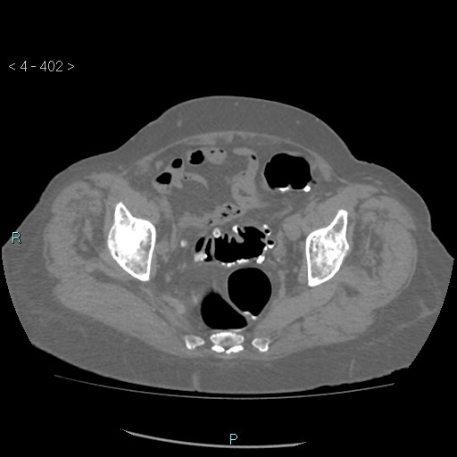 Colonic lipomas (Radiopaedia 49137-54244 Axial bone window 180).jpg