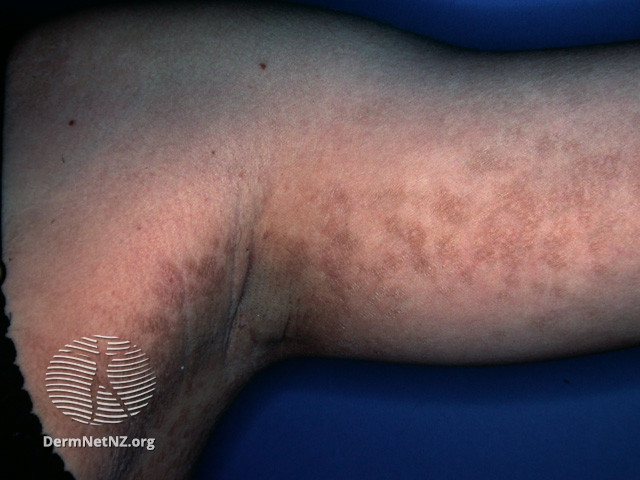 File:Confluent and reticulated papillomatosis (DermNet NZ scaly-crp1).jpg