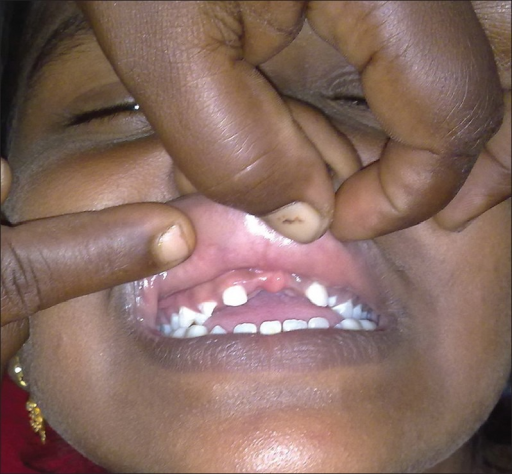 File:Congenital syphilis. Absent teeth.png