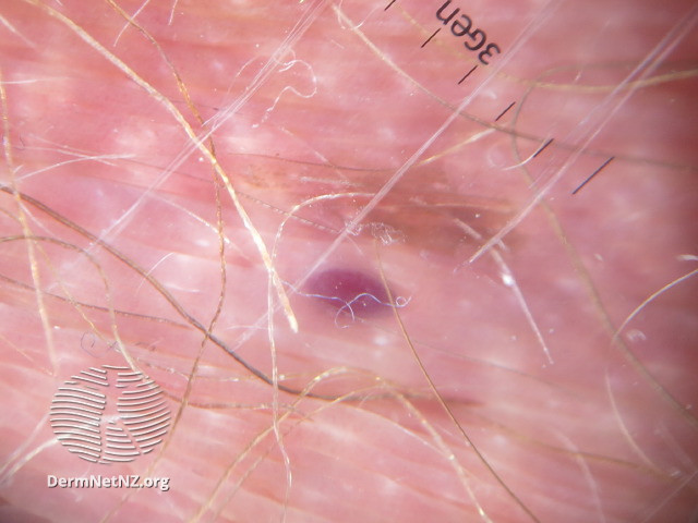 File:Dermoscopy of angiokeratoma of Fordyce on vulva (DermNet NZ angiokeratoma-44).jpg