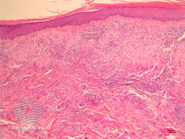 File:Figure 1 (DermNet NZ pathology-e-actinic-granuloma-figure-1).jpg