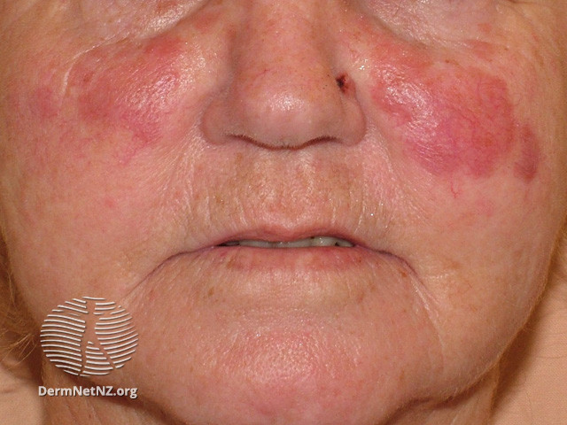 File:Granuloma faciale (DermNet NZ vascular-granuloma-faciale).jpg