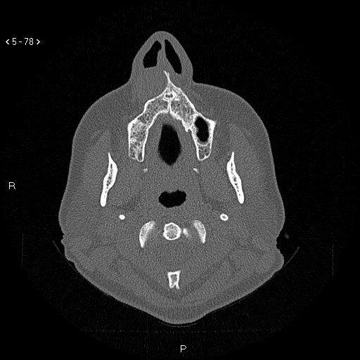 Nasolabial cyst (Radiopaedia 75125-86194 Axial bone window 39).jpg
