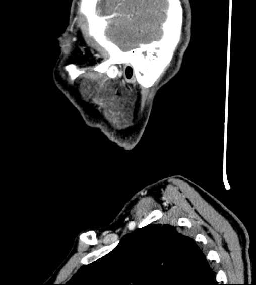 File:Nasopharyngeal carcinoma - infiltrating the clivus (Radiopaedia 62583-70875 C 47).jpg