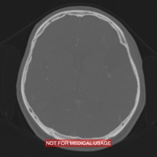 File:Nasopharyngeal carcinoma recurrence - skull base destruction (Radiopaedia 29107-29490 Axial bone window 50).jpg