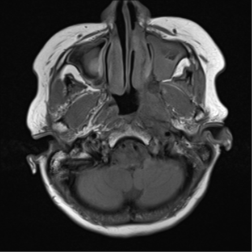 File:Nasopharyngeal carcinoma with cerebral abscess (Radiopaedia 43018-46273 Axial T1 18).png