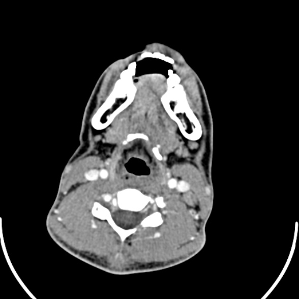 File:Nasopharyngeal carcinoma with skull base invasion (Radiopaedia 53415-59705 A 130).jpg