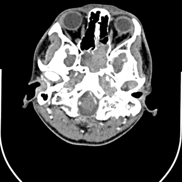 File:Nasopharyngeal carcinoma with skull base invasion (Radiopaedia 53415-59705 A 24).jpg