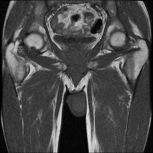 File:Necrotizing epididymo-orchitis with intra-testicular abscess (Radiopaedia 29397-29860 Coronal T1 16).jpg