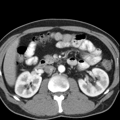 File:Necrotizing pancreatitis with acute necrotic collection (Radiopaedia 14470-14417 B 19).jpg