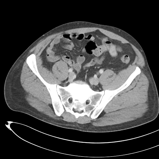 File:Necrotizing pancreatitis with acute necrotic collections (Radiopaedia 38829-41012 B 63).png