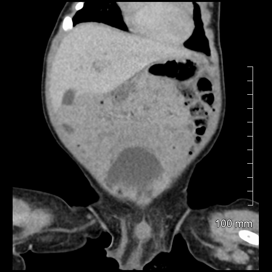File:Neonatal neuroblastoma (Radiopaedia 56651-63438 Coronal non-contrast 15).jpg