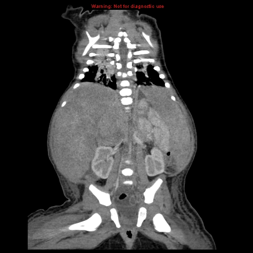 File:Neonatal neuroblastoma (Radiopaedia 9564-10223 B 87).jpg