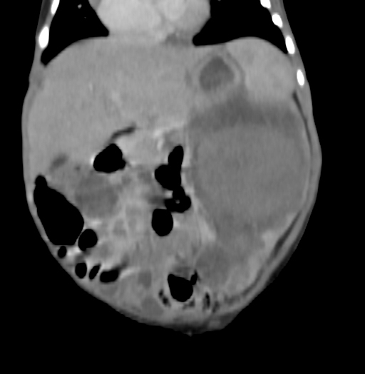 Nephroblastomatosis (Radiopaedia 71294-81607 B 157).jpg