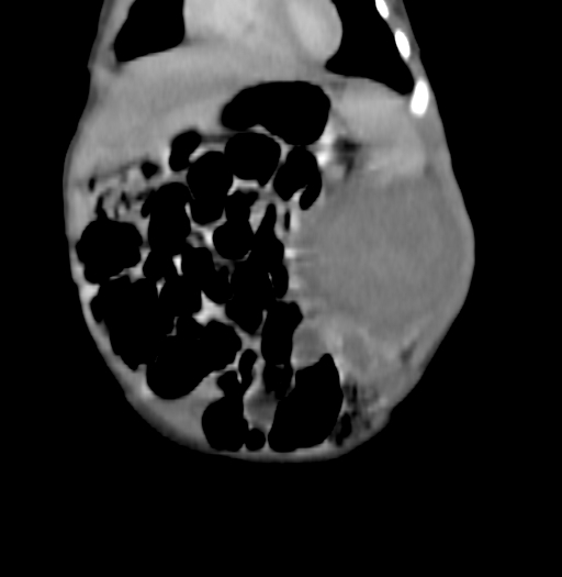 Nephroblastomatosis (Radiopaedia 71294-81607 B 88).jpg