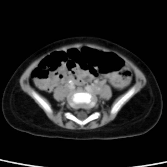 Neuroblastoma with skull metastases (Radiopaedia 30326-30960 C 43).jpg
