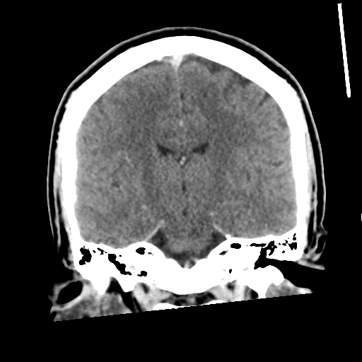 Neurocysticercosis - granular nodular (Radiopaedia 42786-45957 Coronal C+ 36).png
