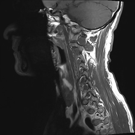File:Neurofibromatosis type 1 (Radiopaedia 80355-93740 Sagittal T1 9).jpg