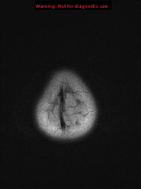 File:Neurofibromatosis type 1 with optic nerve glioma (Radiopaedia 16288-15965 Axial FLAIR 2).jpg