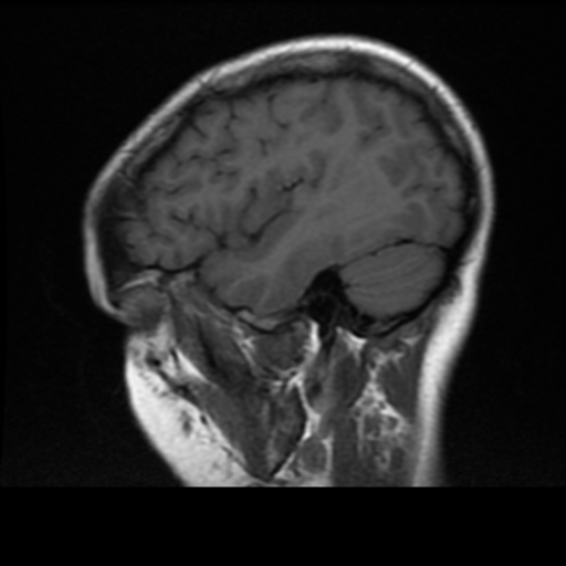 File:Neurofibromatosis type 2 (Radiopaedia 45229-49244 Sagittal T1 4).png