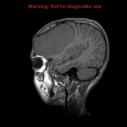 File:Neurofibromatosis type 2 (Radiopaedia 8953-9730 Sagittal T1 17).jpg
