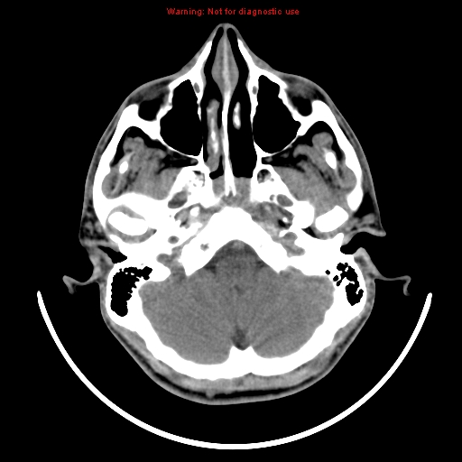File:Neurofibromatosis type 2 (Radiopaedia 8953-9732 Axial non-contrast 4).jpg