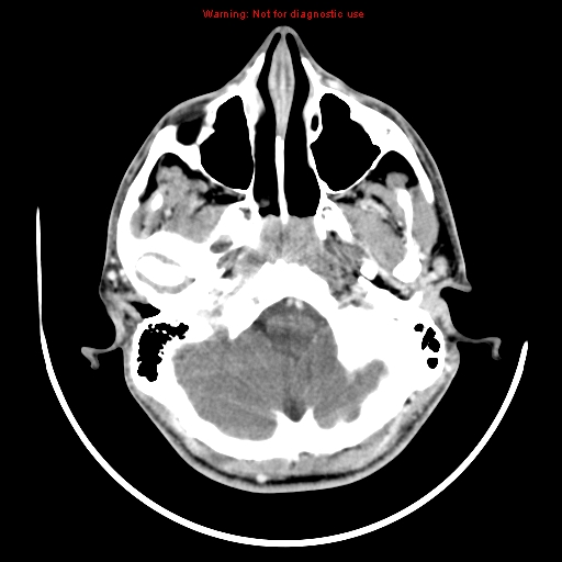 File:Neurofibromatosis type 2 (Radiopaedia 8953-9732 C 2).jpg