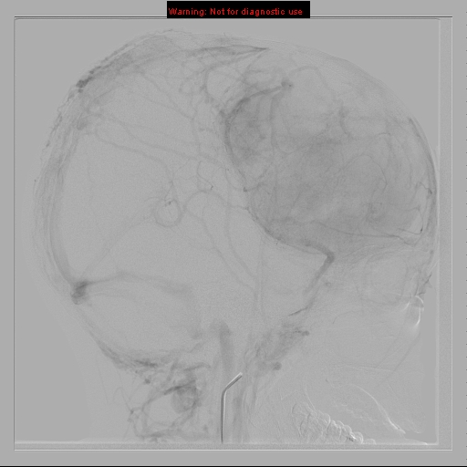 File:Neurofibromatosis type 2 (Radiopaedia 8953-9733 C 21).jpg