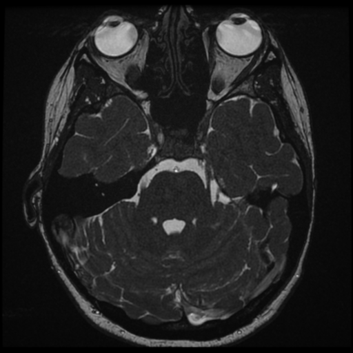 Neurofibromatosis type 2 - bilateral acoustic neuromata (Radiopaedia 40060-42566 Axial FIESTA 55).png
