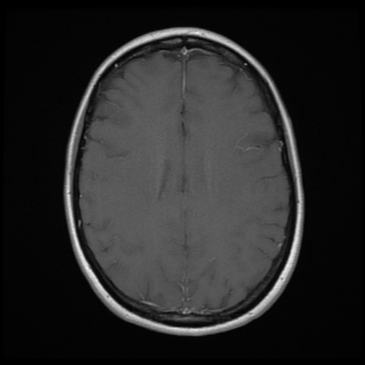 File:Neurofibromatosis type 2 - bilateral acoustic neuromata (Radiopaedia 40060-42566 Axial T1 C+ 14).png