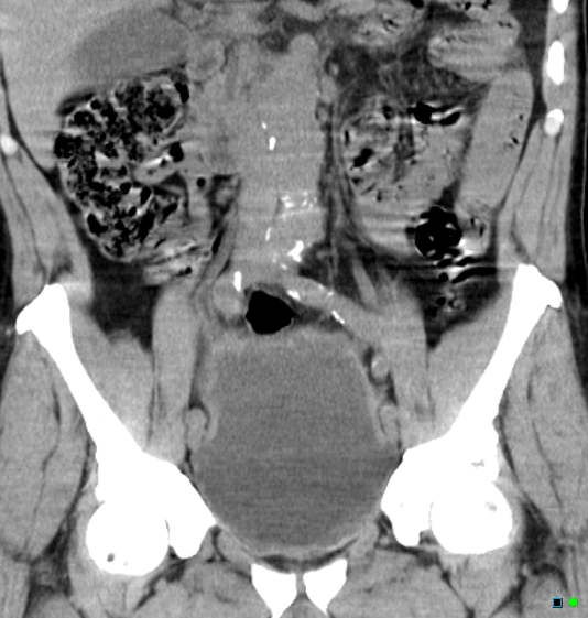 File:Neurogenic bladder - CT findings (Christmas tree bladder) (Radiopaedia 26995-27174 Coronal non-contrast 7).jpg