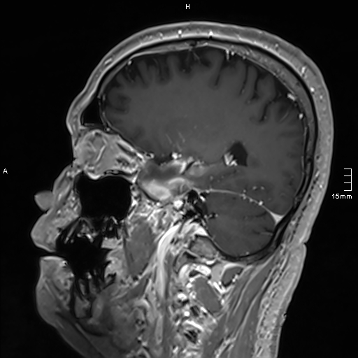 Neurosarcoidosis - involvement of the mesial temporal lobes (Radiopaedia 67429-76820 Sagittal T1 C+ 59).jpg
