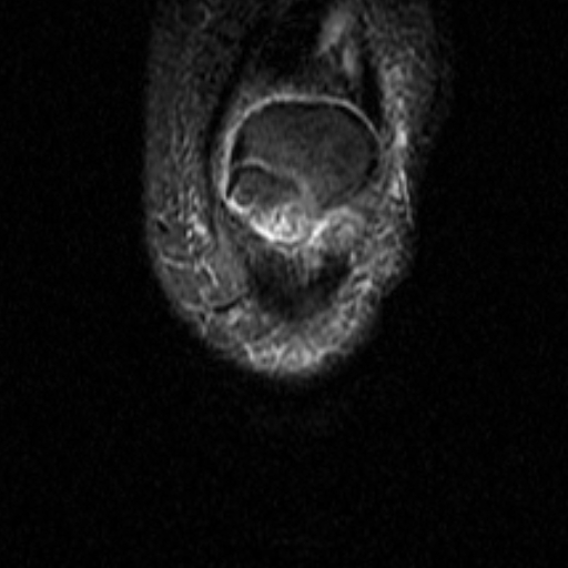 File:Non-displaced patella fracture (Radiopaedia 15932-15582 Coronal STIR 3).jpg