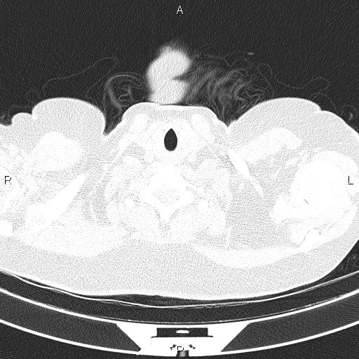 Non-specific interstitial pneumonia (Radiopaedia 83185-97567 Axial lung window 4).jpg
