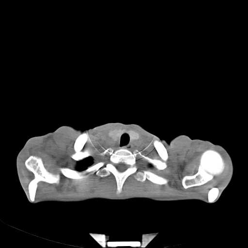 File:Non hodgkin lymphoma of the mediastinum (Radiopaedia 20814-20729 Axial non-contrast 3).jpg