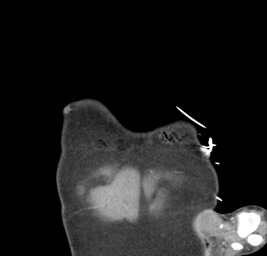 File:Normal CTA thorax (non ECG gated) (Radiopaedia 41750-44704 B 5).png