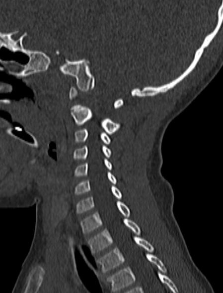 Normal CT cervical spine - pediatric (Radiopaedia 52549-58462 Sagittal bone window 70).jpg