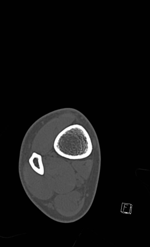 Normal CT of the ankle (Radiopaedia 47111-51658 Axial bone window 6).jpg