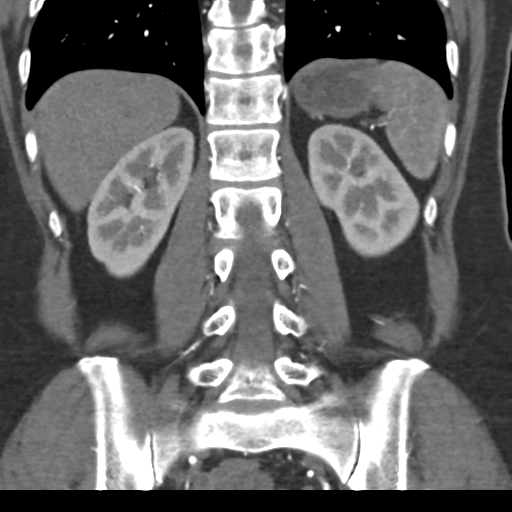 File:Normal CT renal artery angiogram (Radiopaedia 38727-40889 B 55).png