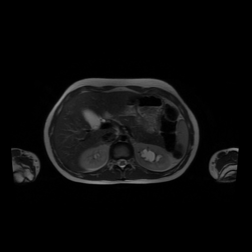 File:Normal MRI abdomen in pregnancy (Radiopaedia 88001-104541 Axial T2 15).jpg