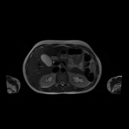 File:Normal MRI abdomen in pregnancy (Radiopaedia 88001-104541 Axial T2 16).jpg