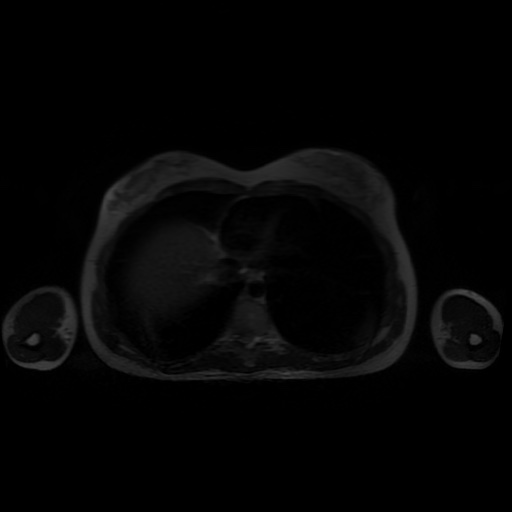 File:Normal MRI abdomen in pregnancy (Radiopaedia 88001-104541 Axial T2 2).jpg