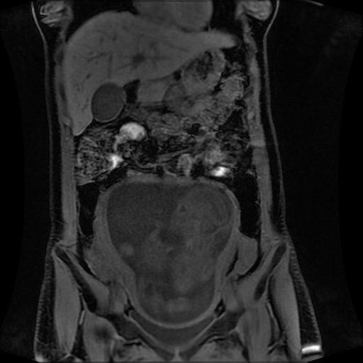 Normal MRI abdomen in pregnancy (Radiopaedia 88001-104541 M 55).jpg