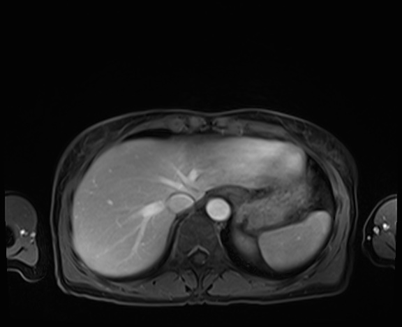 Normal adrenal glands MRI (Radiopaedia 82017-96004 K 14).jpg