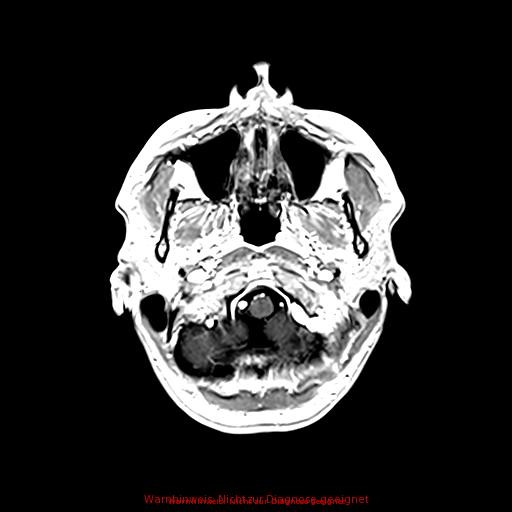 Normal adult brain MRI (non-enhanced and contrast-enhanced) (Radiopaedia 75262-86379 Axial T1 C+ 43).jpg