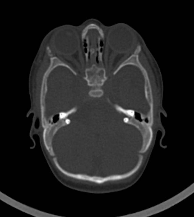Normal brain CT - 2-month-old (Radiopaedia 53369-59350 Axial bone window 46).jpg