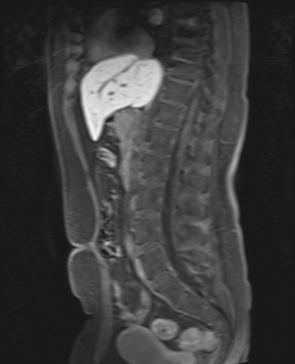 File:Normal hepatobiliary phase liver MRI (Radiopaedia 58968-66230 C 40).jpg